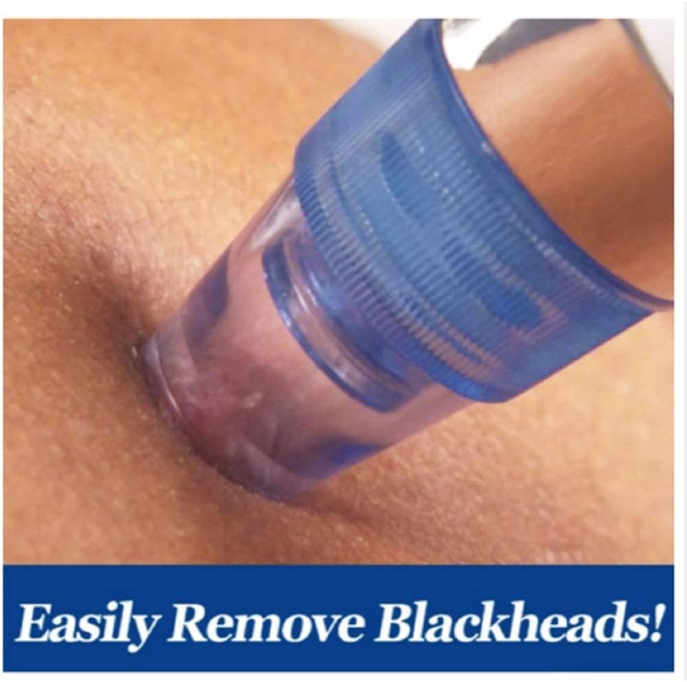 💆‍♀️ Pore Cleaning Device ✨ | Blackhead Remover Vacuum 🔋 USB Rechargeable 🌟